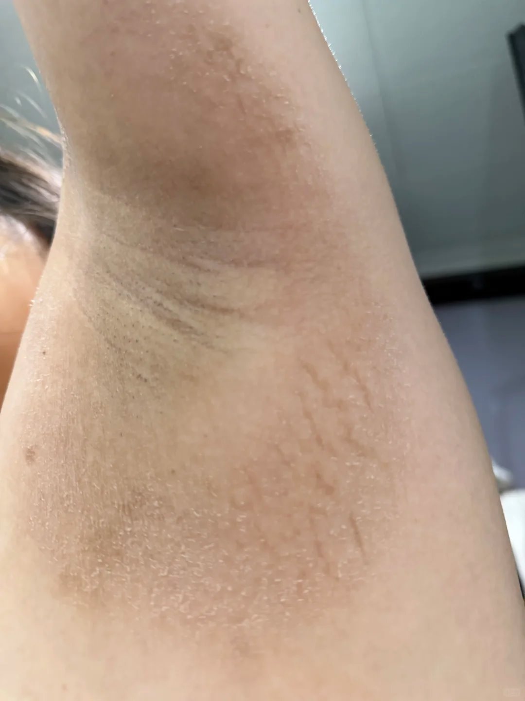腋毛處晶狀顆粒狀態照片